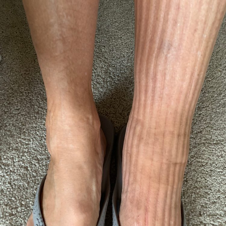 legCompression